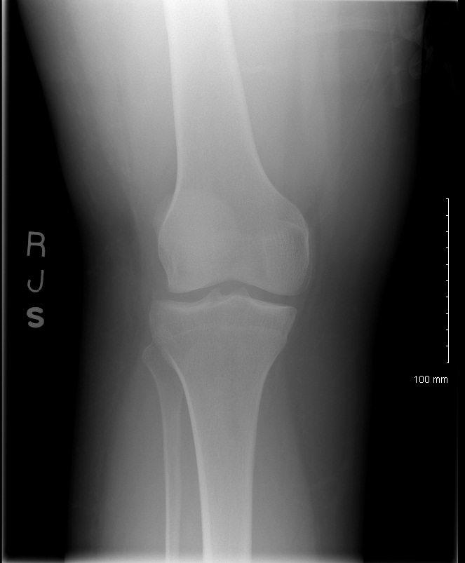 20120803 - Knee Front View.jpg