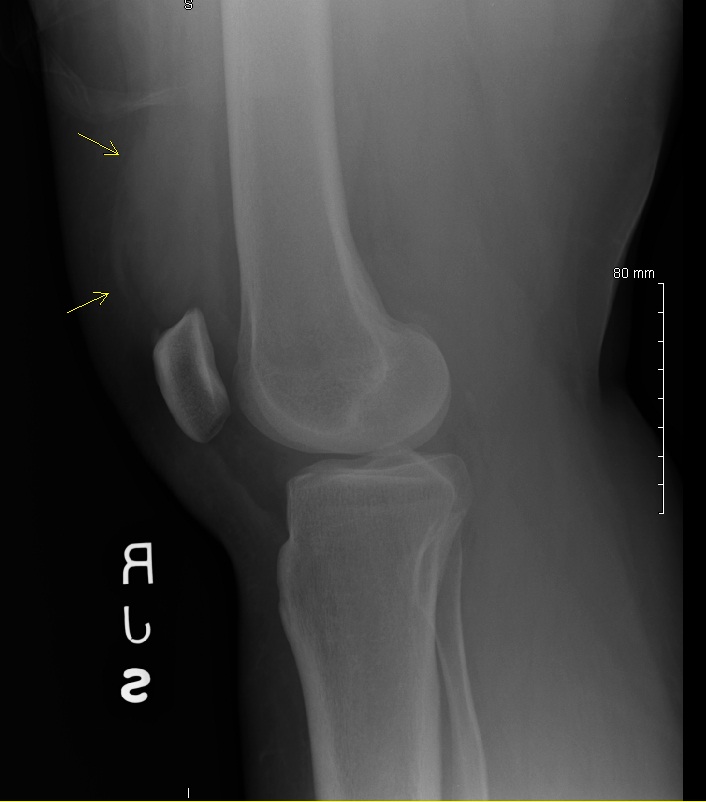 20120803 - Knee Side View.jpg