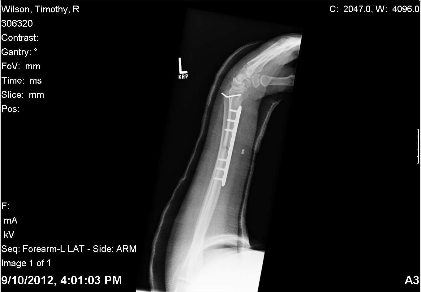 20120910 - Arm Side View.jpg