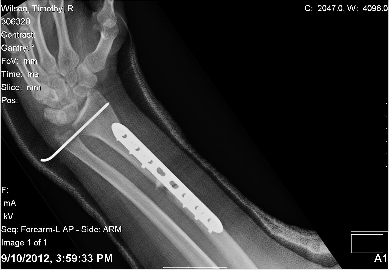 20120910 - Arm Top View Wrist.jpg