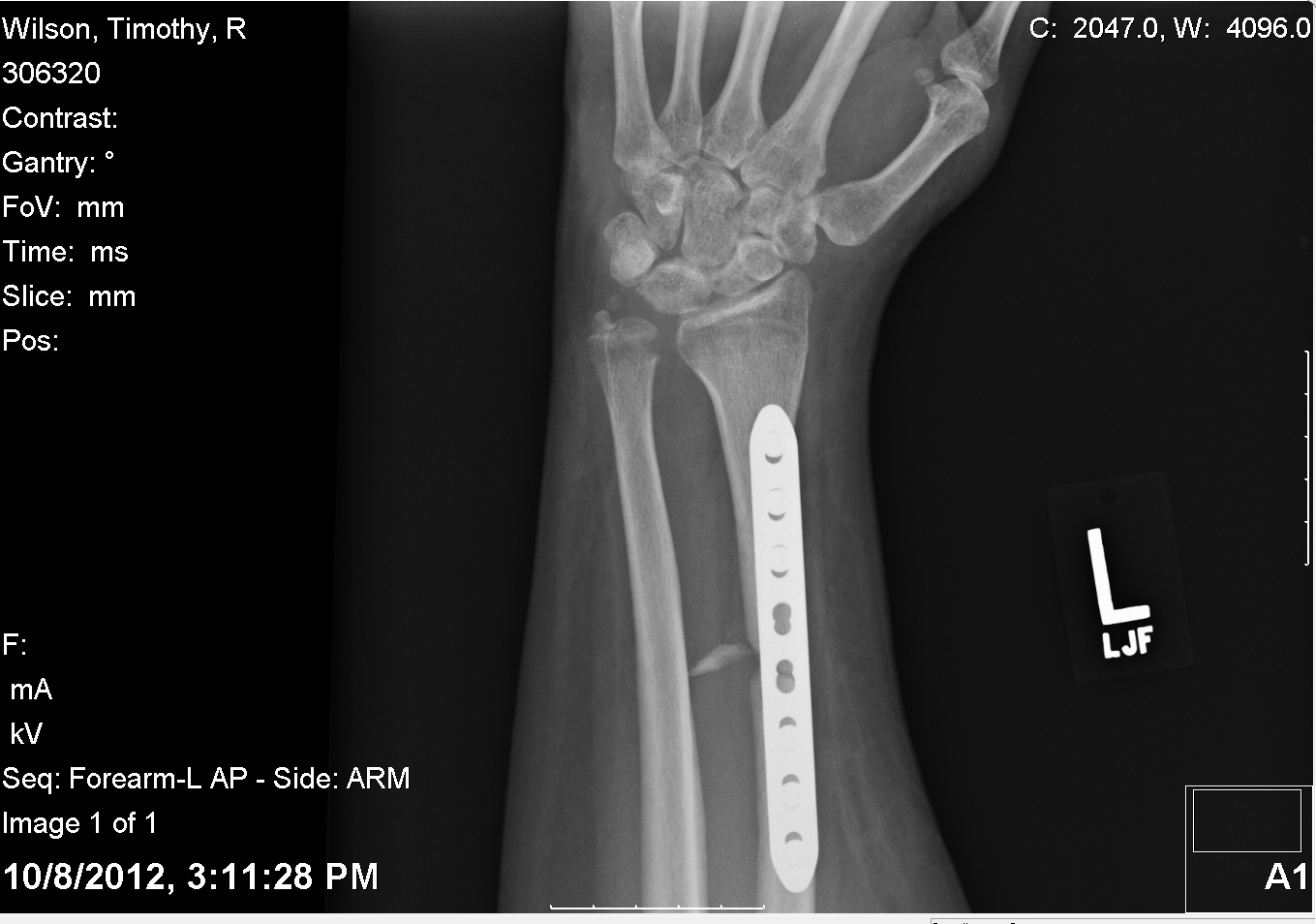 20121008 - Arm Top View Wrist.jpg