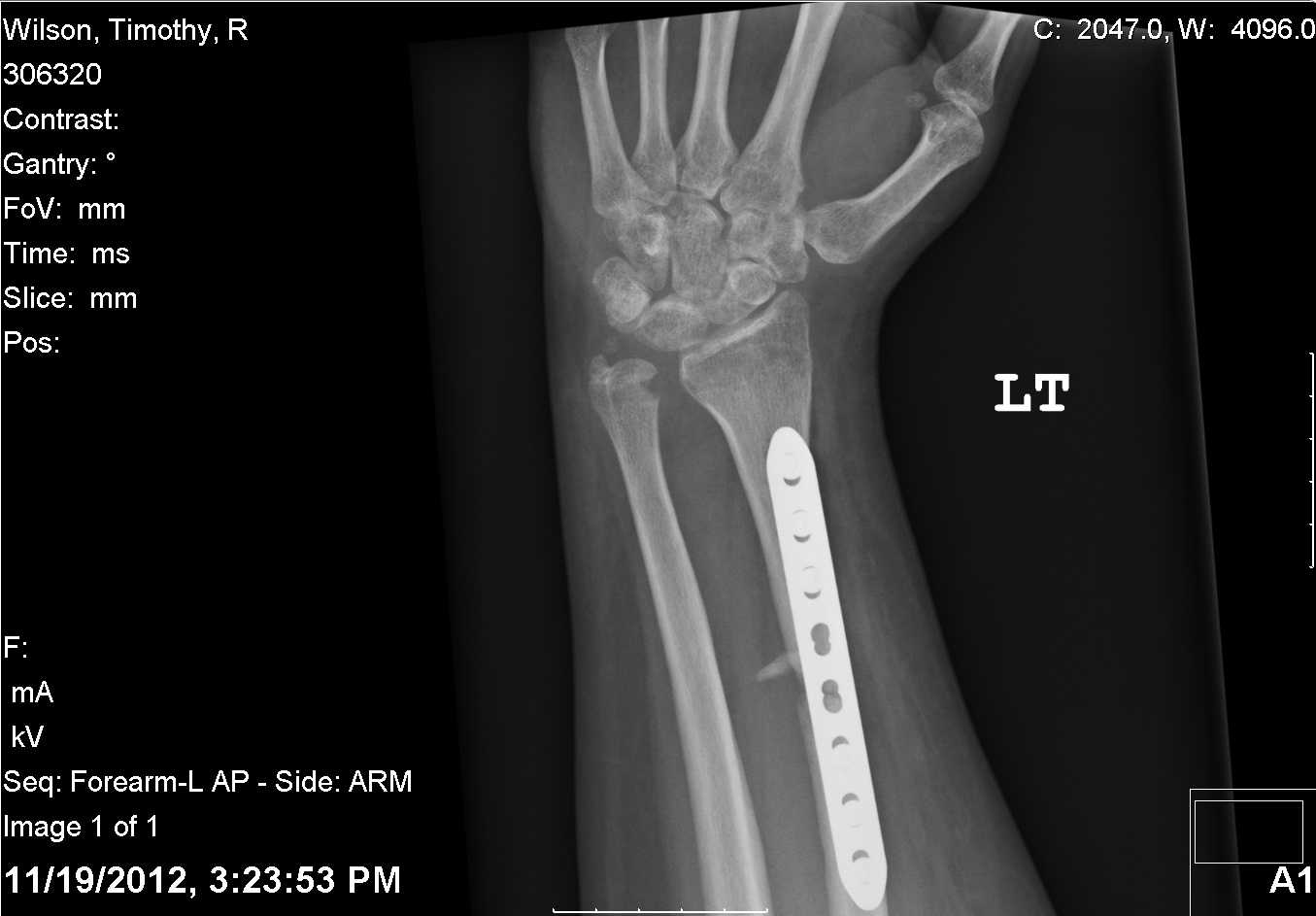 20121119 - Arm Top View Wrist.jpg